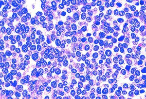نمای سلولی از تومور سارکومای یوئینگ