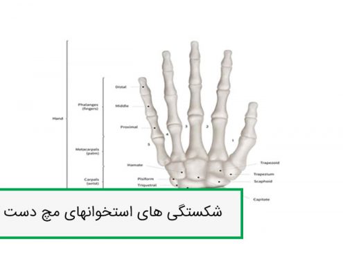 شکستگی های استخوانهای مچ دست