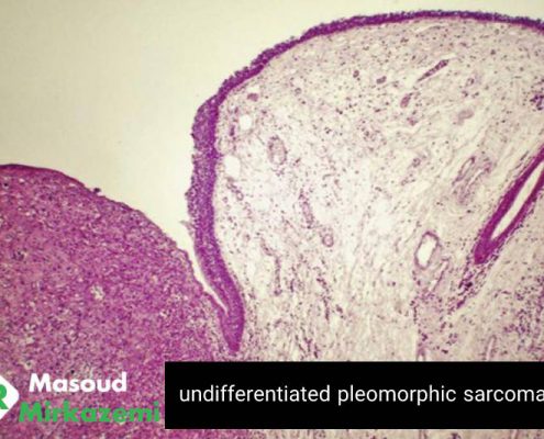 Undifferentiated pleomorphic sarcoma