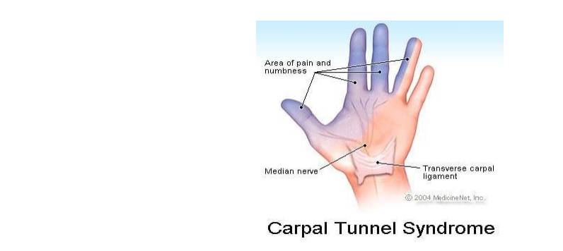 علائم بالینی سندروم تونل کارپال