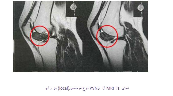 نمای T1 MRI از PVNS نوع موضعی)local )در زانو